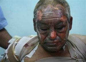 Palestinian Adel Khalefa is treated for burns at Gaza City's Shifa hospital on Sunday, Jan. 11, 2009. Human Rights Watch said Sunday that Israel's military has fired artillery shells packed with the incendiary agent white phosphorus over populated areas of Gaza, putting civilians at risk. The rights group, however, said it had no way to confirm whether people were injured by the substance. (AP Photo/Ashraf Amra)